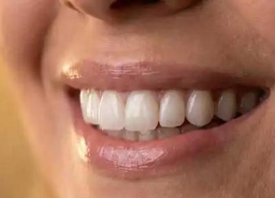 از لمینت تا لومینیرز؛ نقش تکنولوژی سرامیک در طراحی لبخند شما